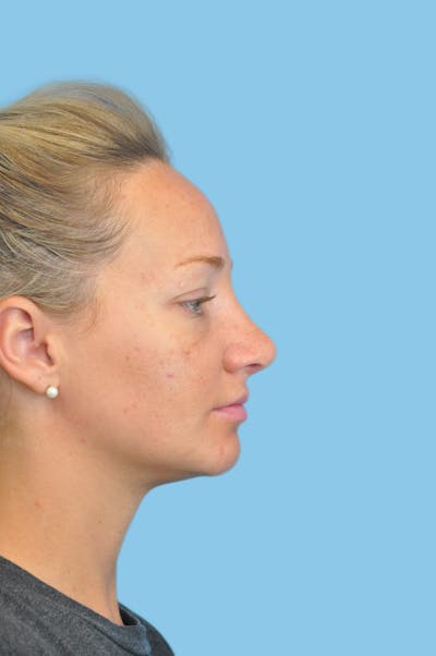 Revision Rhinoplasty Before & After Gallery - Patient 138078 - Image 2