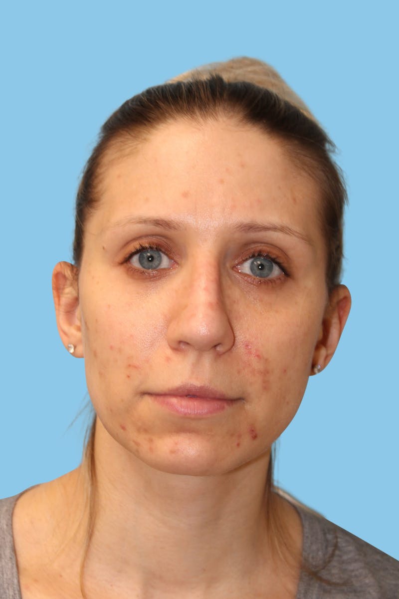 Revision Rhinoplasty Before & After Gallery - Patient 400107 - Image 2