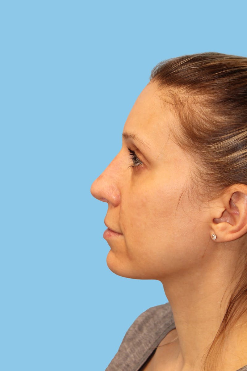 Revision Rhinoplasty Before & After Gallery - Patient 400107 - Image 4