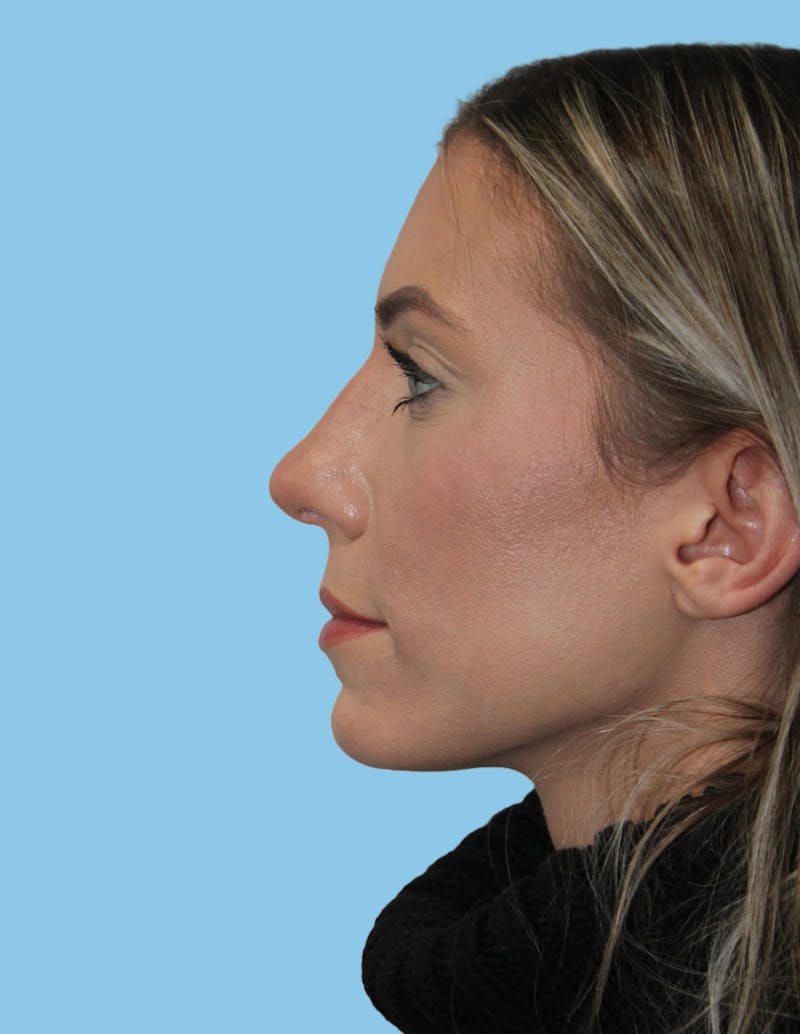 Revision Rhinoplasty Before & After Gallery - Patient 400107 - Image 3
