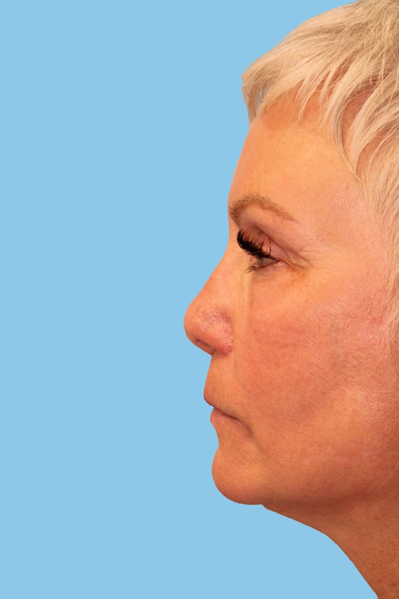 Revision Rhinoplasty Before & After Gallery - Patient 295743 - Image 3
