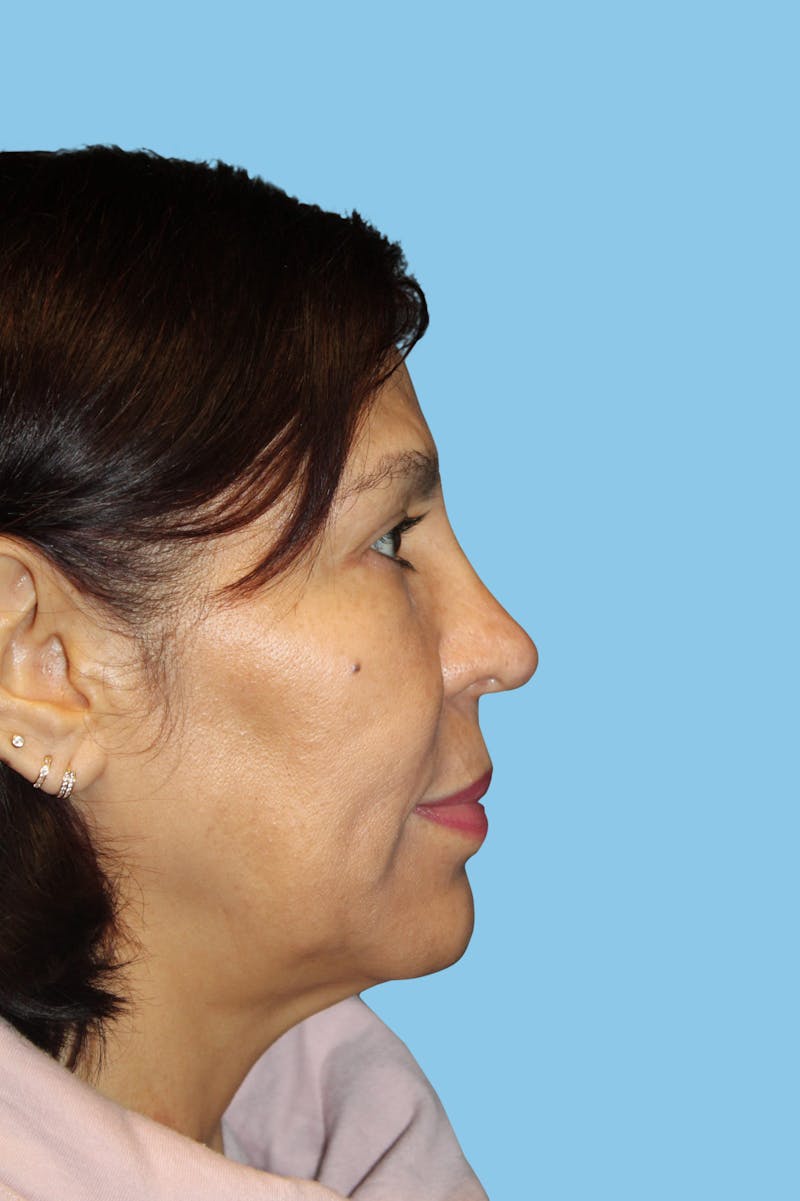 Revision Rhinoplasty Before & After Gallery - Patient 164888 - Image 4
