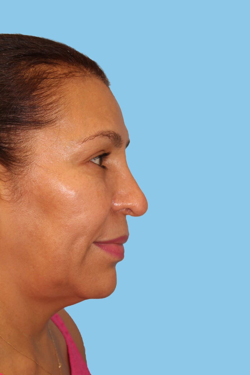 Revision Rhinoplasty Before & After Gallery - Patient 164888 - Image 3