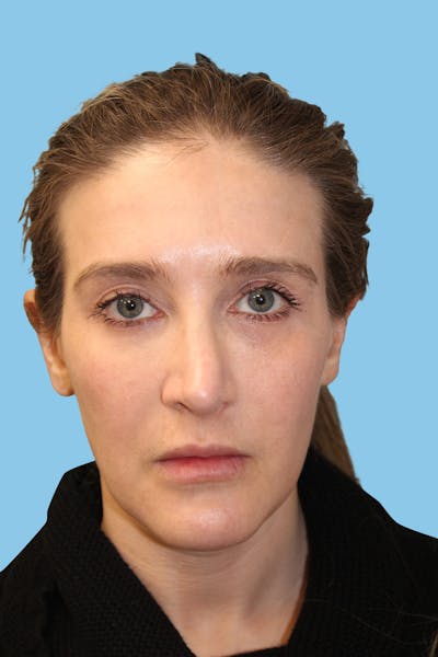 Revision Rhinoplasty Before & After Gallery - Patient 202237 - Image 1
