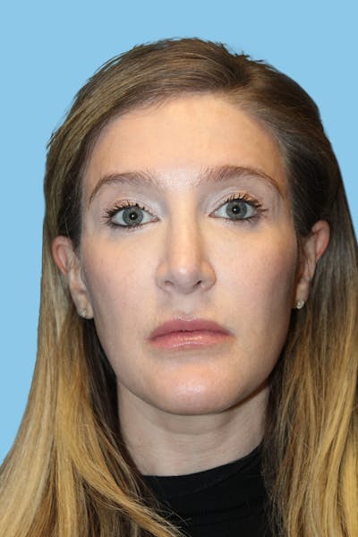 Revision Rhinoplasty Before & After Gallery - Patient 202237 - Image 2
