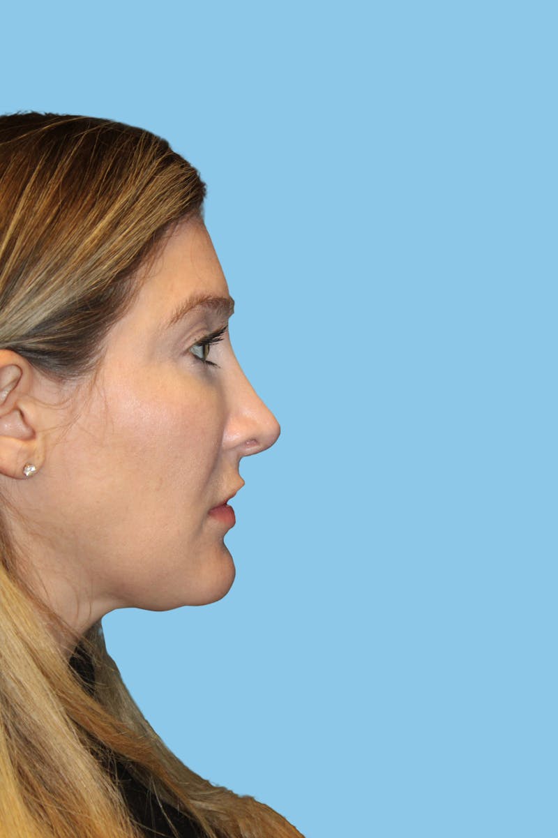 Revision Rhinoplasty Before & After Gallery - Patient 202237 - Image 4
