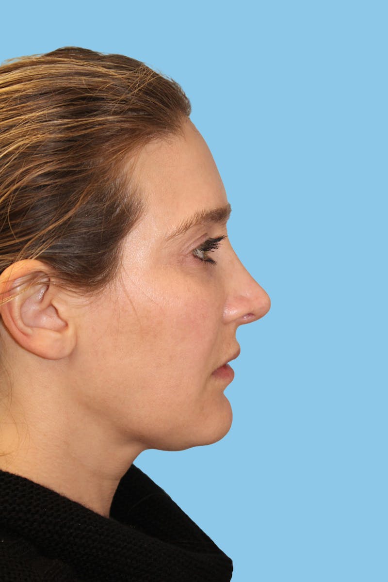 Revision Rhinoplasty Before & After Gallery - Patient 202237 - Image 3
