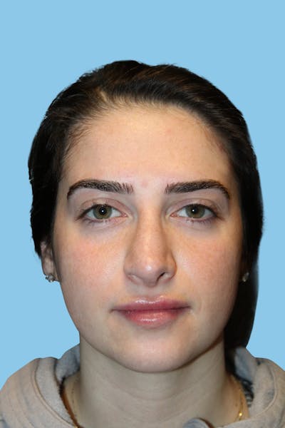 Revision Rhinoplasty Before & After Gallery - Patient 928696 - Image 2