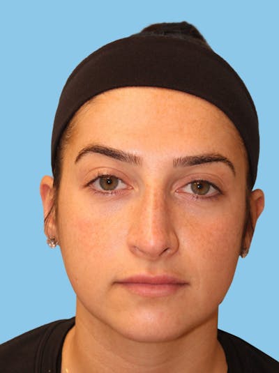 Revision Rhinoplasty Before & After Gallery - Patient 928696 - Image 1