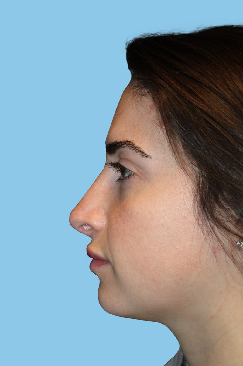 Revision Rhinoplasty Before & After Gallery - Patient 928696 - Image 4