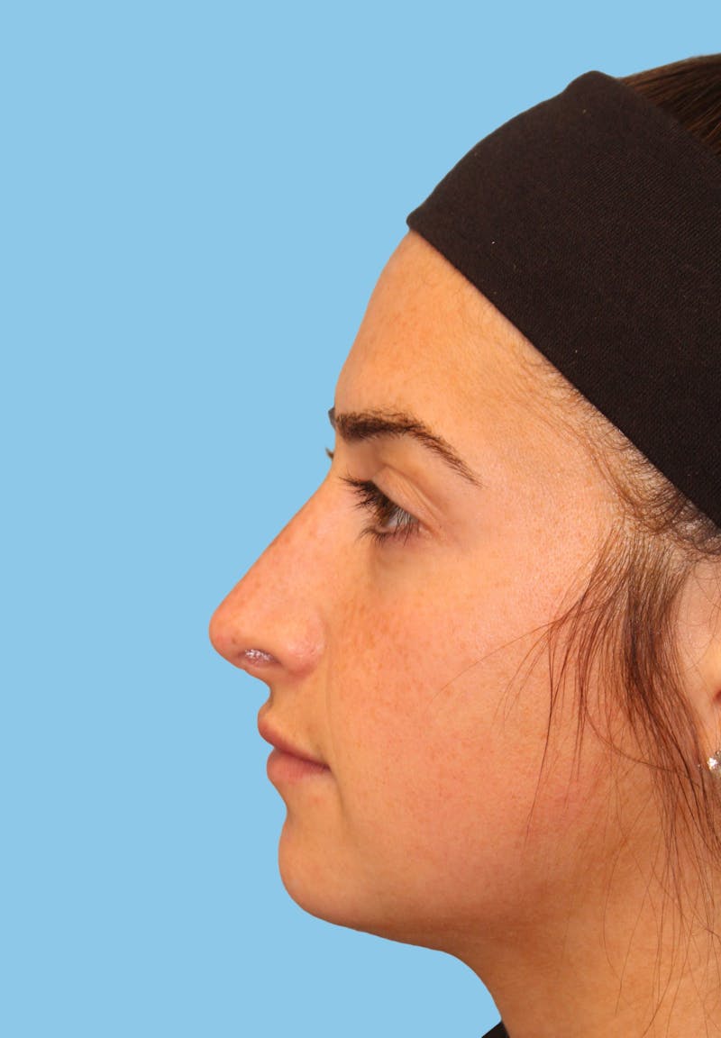 Revision Rhinoplasty Before & After Gallery - Patient 928696 - Image 3