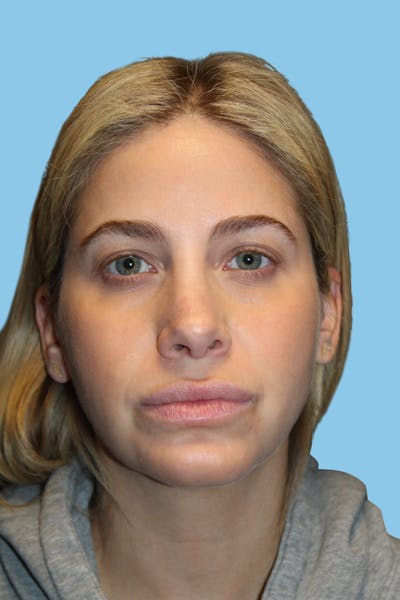 Revision Rhinoplasty Before & After Gallery - Patient 233791 - Image 2