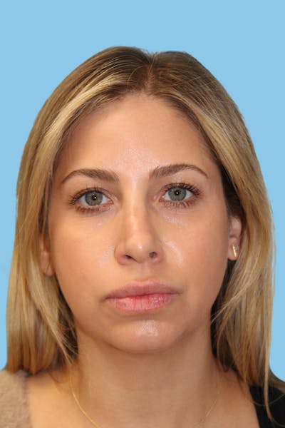 Revision Rhinoplasty Before & After Gallery - Patient 233791 - Image 1