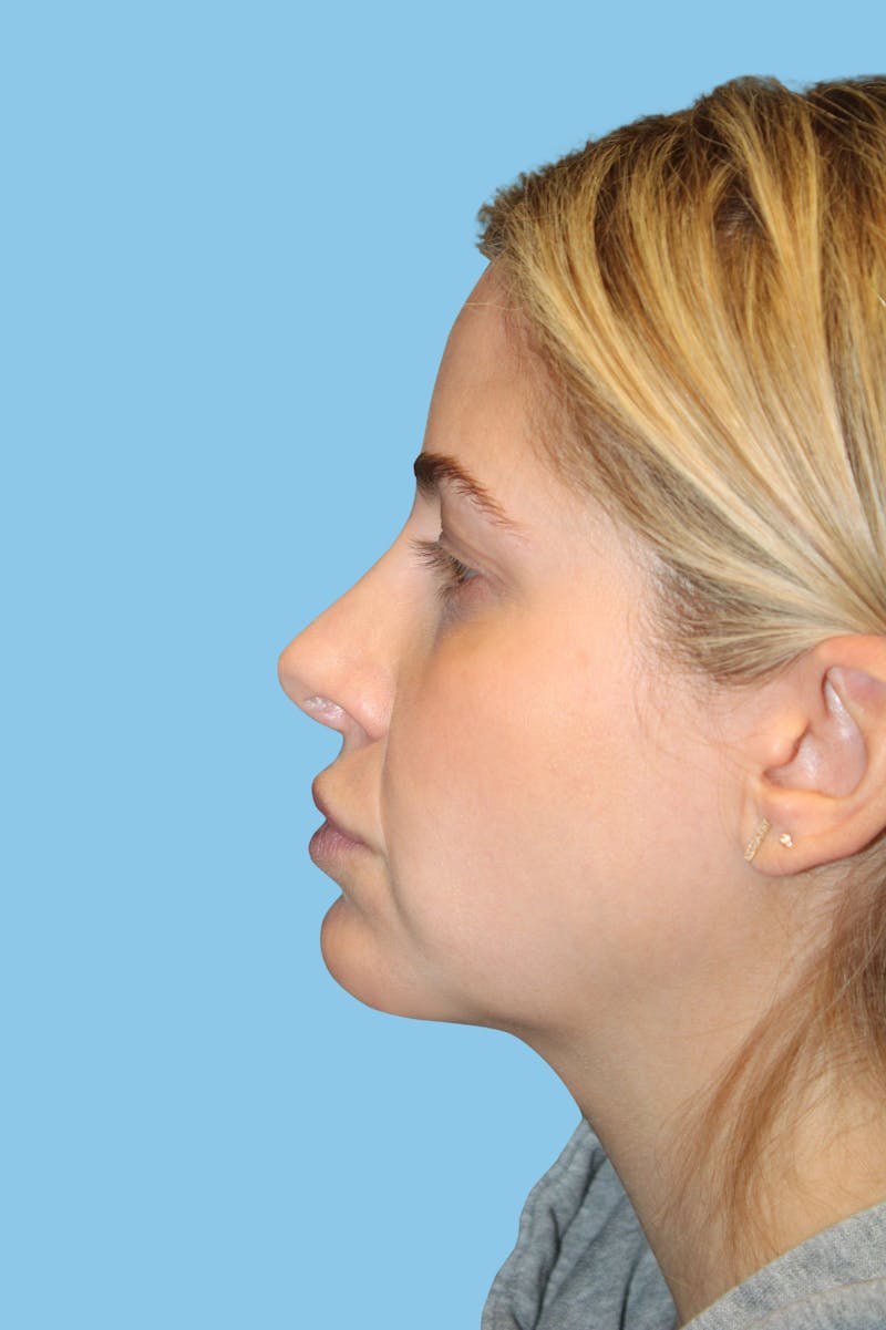 Revision Rhinoplasty Before & After Gallery - Patient 233791 - Image 4