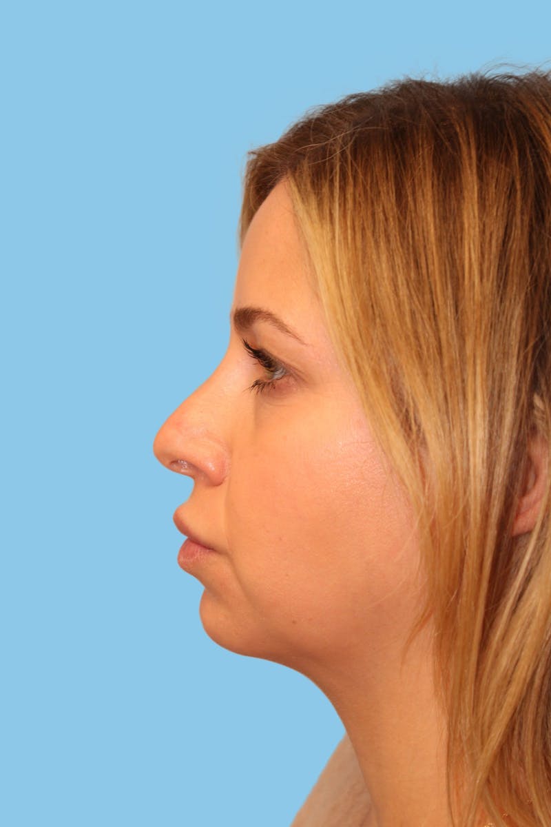 Revision Rhinoplasty Before & After Gallery - Patient 233791 - Image 3