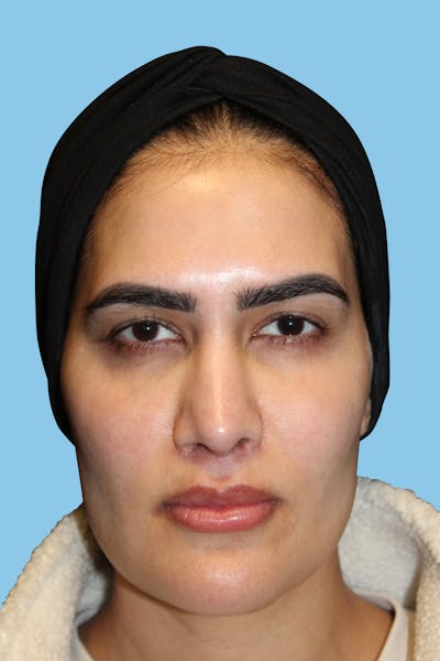 Revision Rhinoplasty Before & After Gallery - Patient 320512 - Image 2