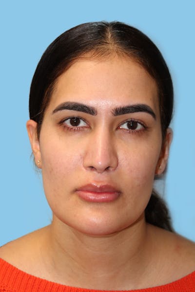 Revision Rhinoplasty Before & After Gallery - Patient 320512 - Image 1