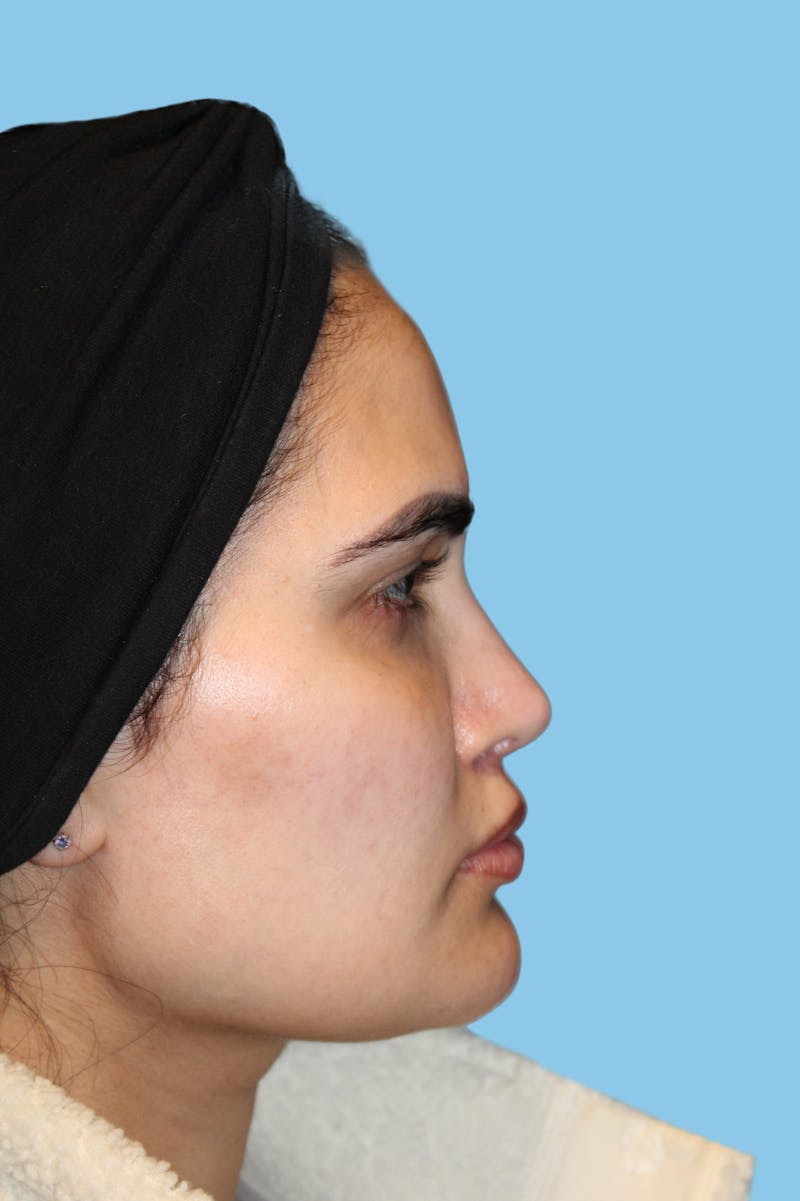 Revision Rhinoplasty Before & After Gallery - Patient 320512 - Image 4