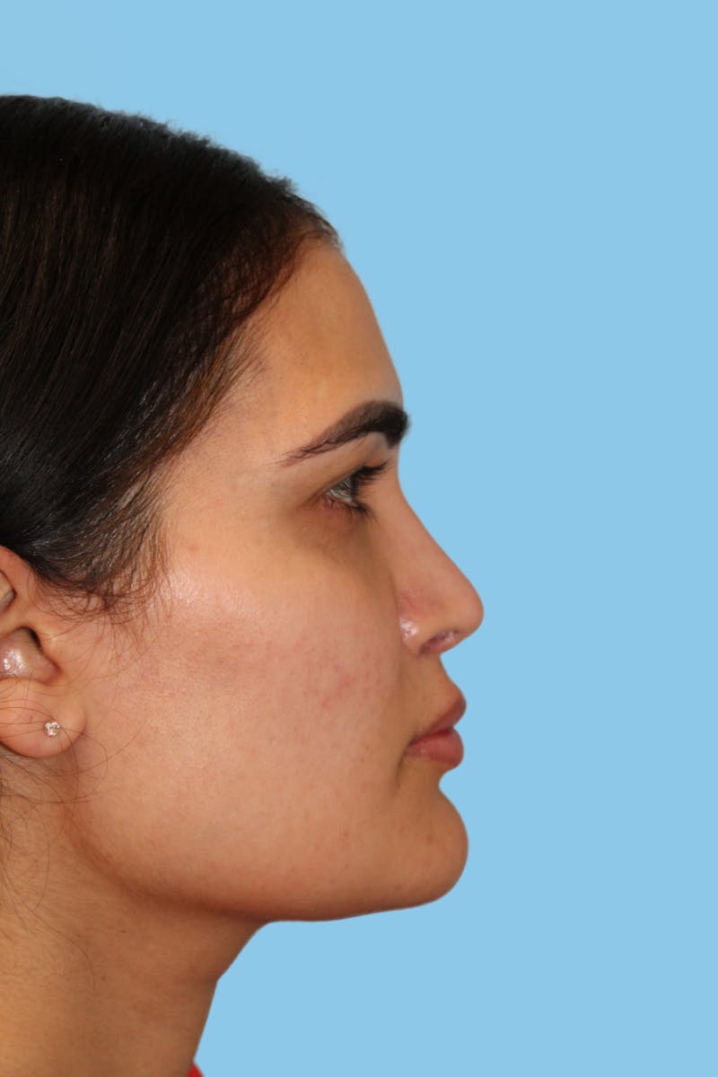 Revision Rhinoplasty Before & After Gallery - Patient 320512 - Image 3