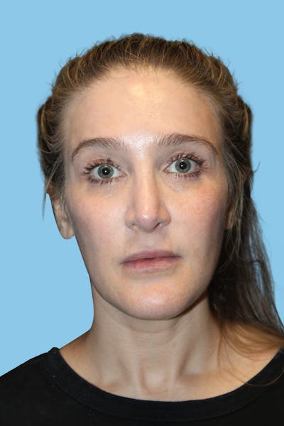 Revision Rhinoplasty Before & After Gallery - Patient 101784 - Image 2