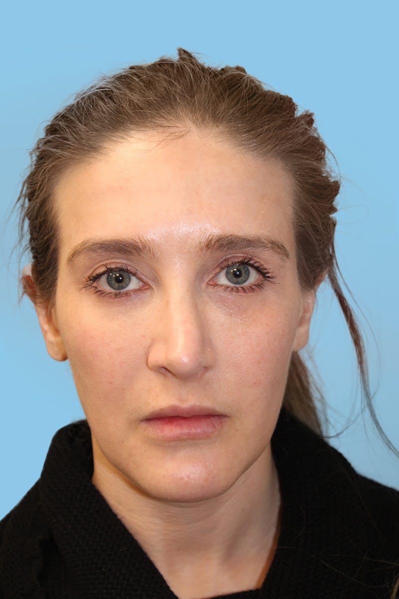 Revision Rhinoplasty Before & After Gallery - Patient 101784 - Image 1