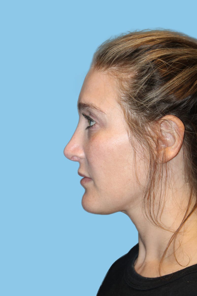 Revision Rhinoplasty Before & After Gallery - Patient 101784 - Image 4