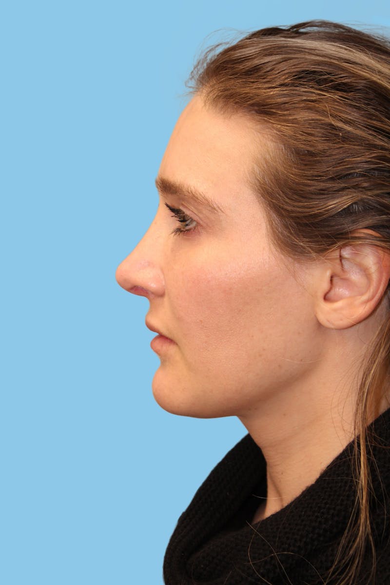 Revision Rhinoplasty Before & After Gallery - Patient 101784 - Image 3