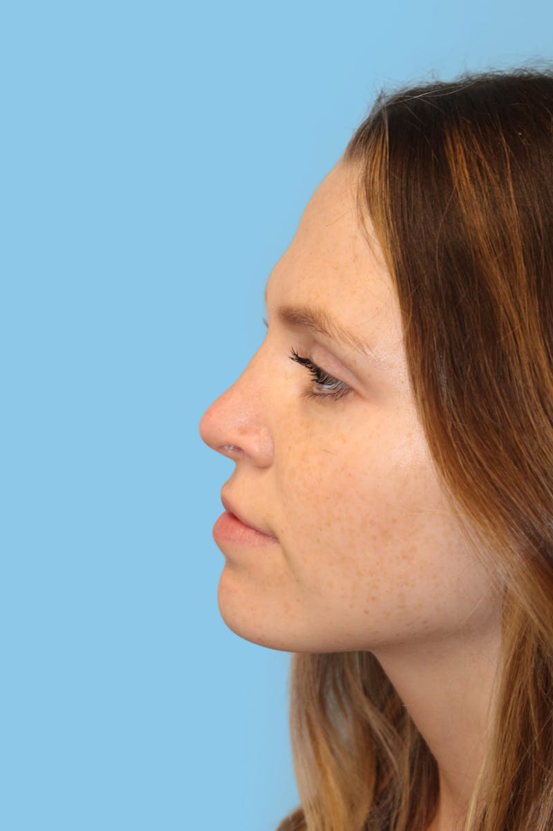 Rhinoplasty Before & After Gallery - Patient 161124 - Image 4