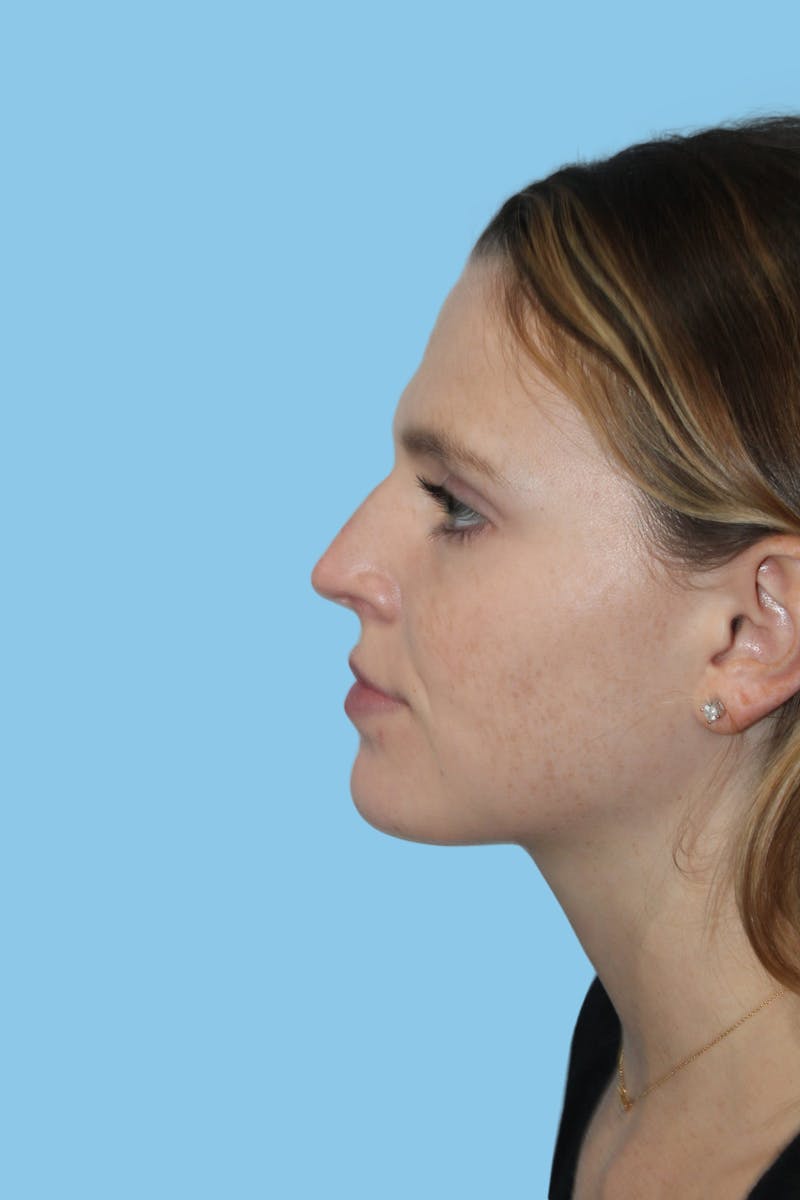 Rhinoplasty Before & After Gallery - Patient 161124 - Image 3