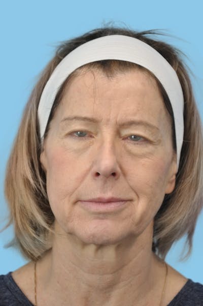 Facelift & Necklift Before & After Gallery - Patient 352786 - Image 1