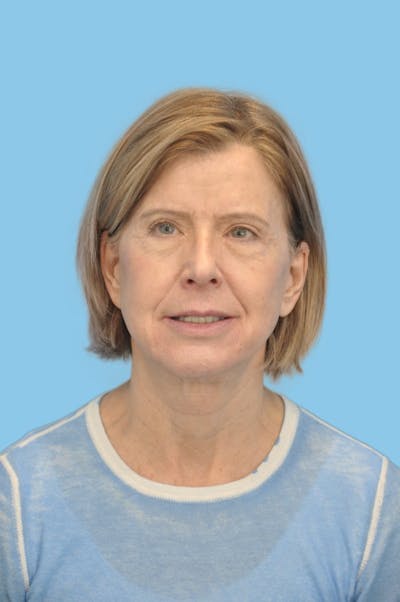 SWIFT LIFT ® / Facelift / Necklift  Before & After Gallery - Patient 352786 - Image 2