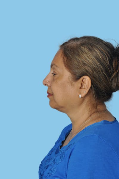 SWIFT LIFT ® / Facelift / Necklift  Before & After Gallery - Patient 249999 - Image 1