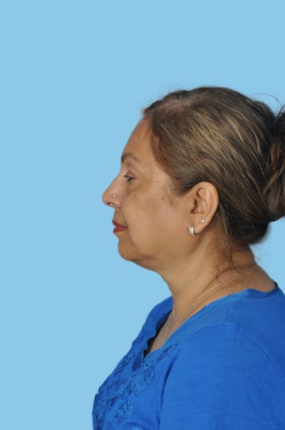 Facelift & Necklift Before & After Gallery - Patient 249999 - Image 1