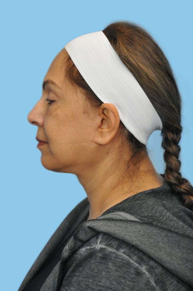 Facelift & Necklift Before & After Gallery - Patient 249999 - Image 2