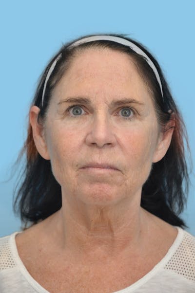 SWIFT LIFT ® / Facelift / Necklift  Before & After Gallery - Patient 181896 - Image 1
