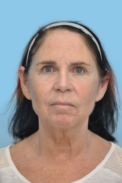 Facelift & Necklift Before & After Gallery - Patient 181896 - Image 1