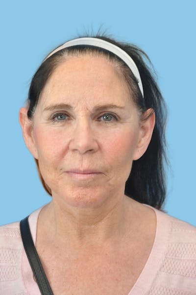 Facelift & Necklift Before & After Gallery - Patient 181896 - Image 2