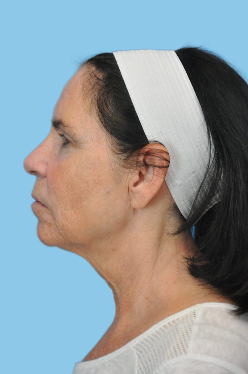 Facelift & Necklift Before & After Gallery - Patient 181896 - Image 3