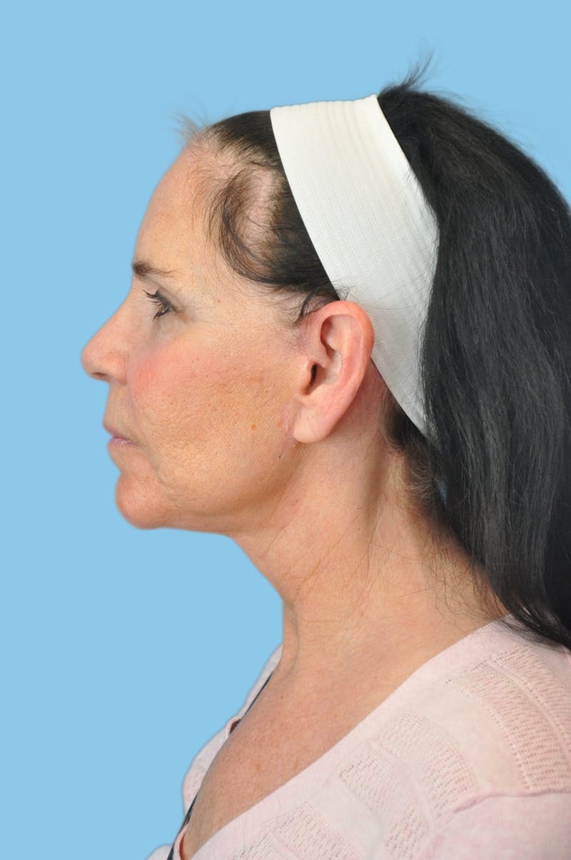 Facelift & Necklift Before & After Gallery - Patient 181896 - Image 4