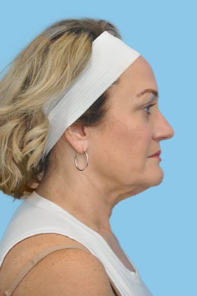 Facelift & Necklift Before & After Gallery - Patient 128983 - Image 1