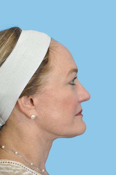 Facelift & Necklift Before & After Gallery - Patient 128983 - Image 2