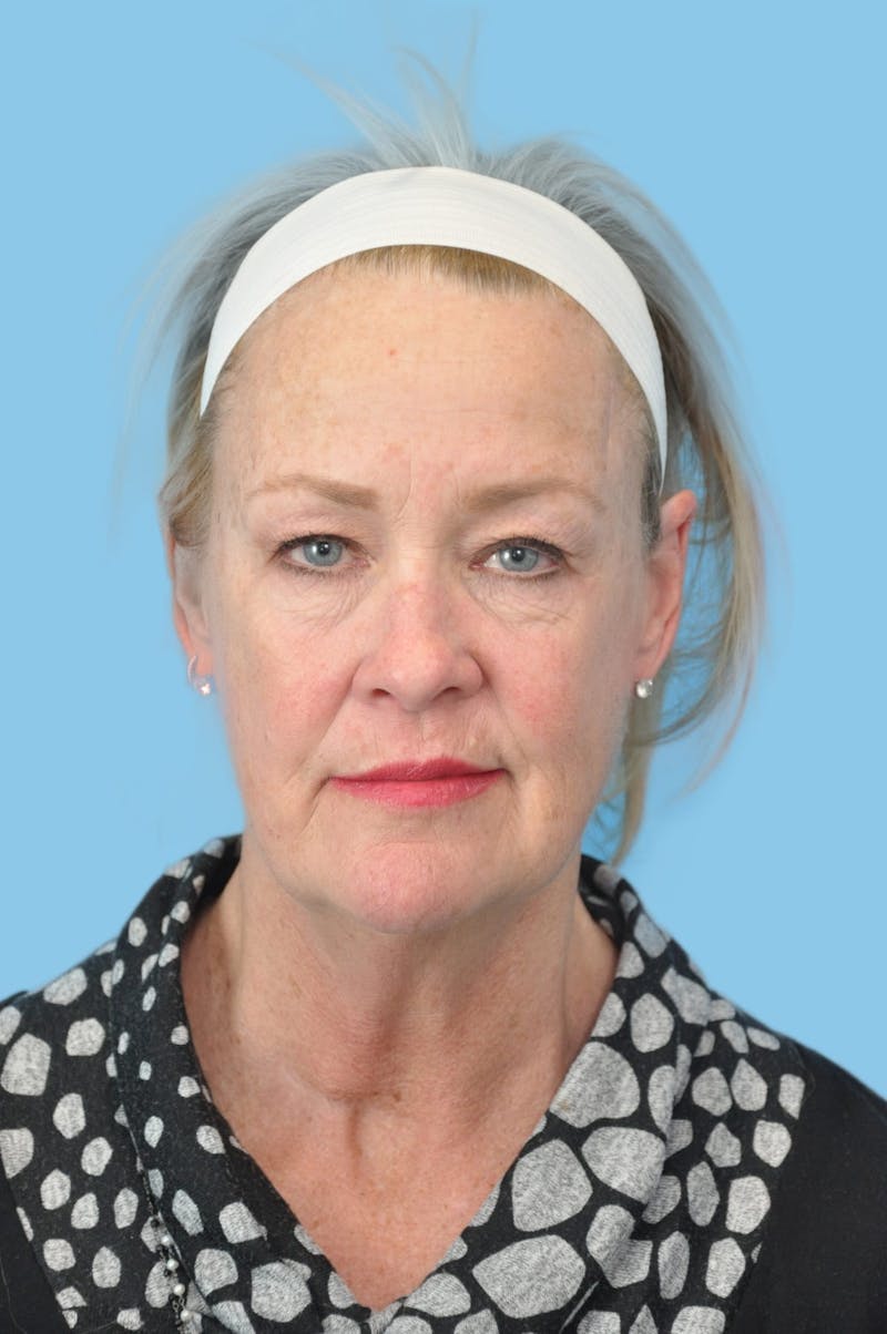 Facelift & Necklift Before & After Gallery - Patient 183994 - Image 1
