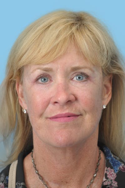 SWIFT LIFT ® / Facelift / Necklift  Before & After Gallery - Patient 183994 - Image 2