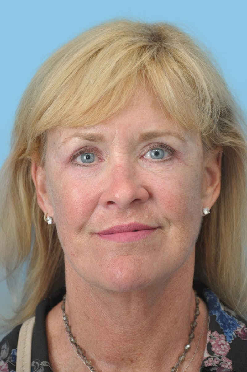SWIFT LIFT ® / Facelift / Necklift  Before & After Gallery - Patient 183994 - Image 2