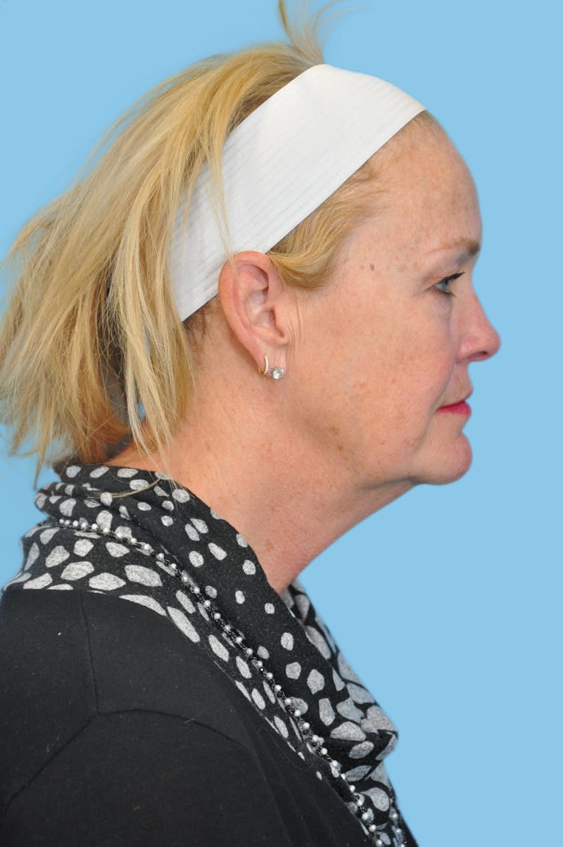 Facelift & Necklift Before & After Gallery - Patient 183994 - Image 3