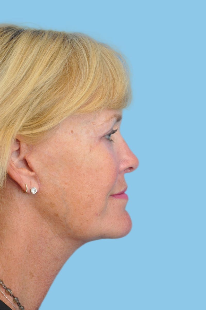 Facelift & Necklift Before & After Gallery - Patient 183994 - Image 4