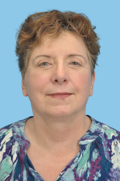 SWIFT LIFT ® / Facelift / Necklift  Before & After Gallery - Patient 479666 - Image 2