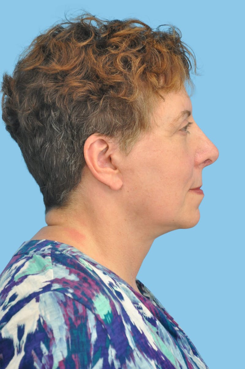 Facelift & Necklift Before & After Gallery - Patient 479666 - Image 4