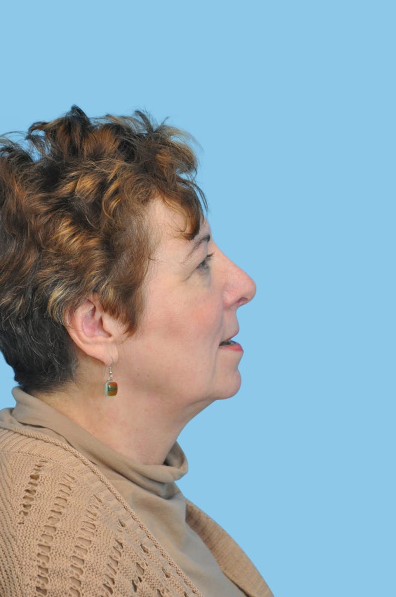 SWIFT LIFT ® / Facelift / Necklift  Before & After Gallery - Patient 479666 - Image 3