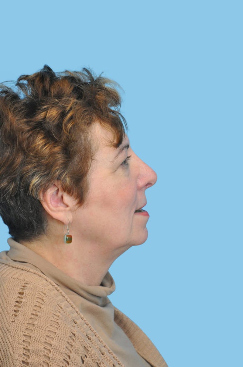 Facelift & Necklift Before & After Gallery - Patient 479666 - Image 3
